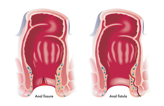 Preventing Piles, Fissures, and Fistula: Lifestyle Tips and Medical Care in Punjab