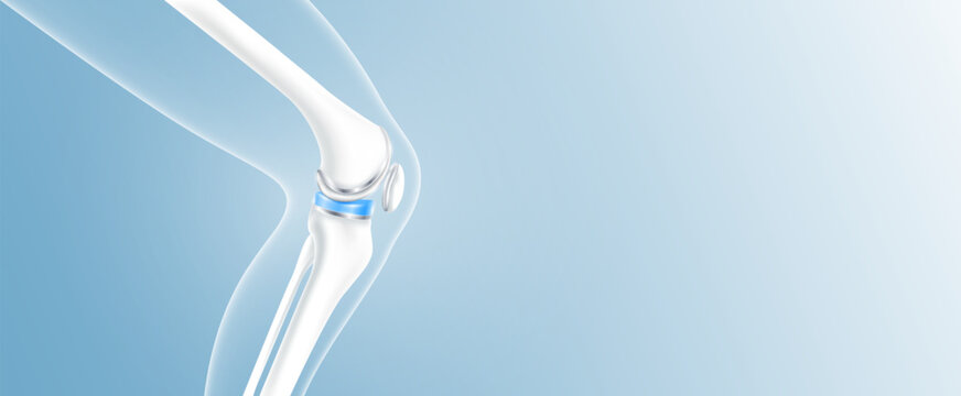 The Evolution of Knee Implants: Choosing the Right Option for Your Lifestyle
