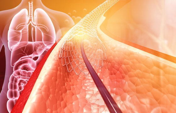 Effective TAVR Surgery at Livasa Hoshiarpur - Proven Valve Replacement