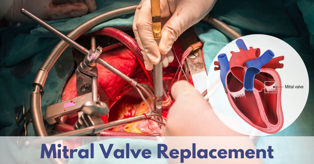 Mitral Valve Surgery at Livasa Mohali - Expert Cardiac Procedures