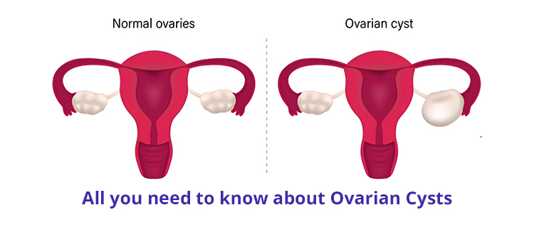 All you need to know about Ovarian Cysts