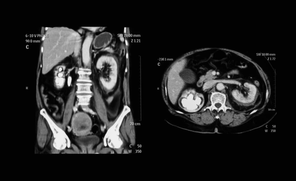 KUB (Kidney, Ureter, Bladder) CT Scan: What Areas Does It Cover in Punjab