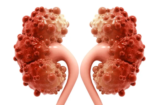 Polycystic Kidney Disease at Livasa Mohali - PKD Treatment