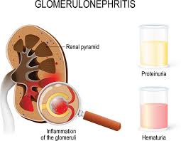 Glomerulonephritis Treatment at Livasa Mohali - Kidney Inflammation Care