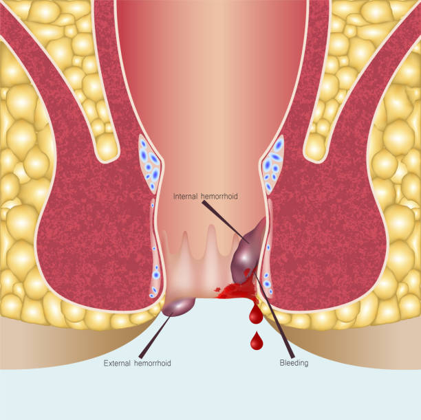 Hemorrhoids vs Anal Fissures: How to Spot the Difference and Get Proper Treatment