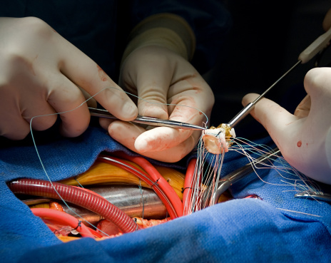 Gentle Aortic Valve Surgery at Livasa Nawanshahr - Caring Heart Procedures