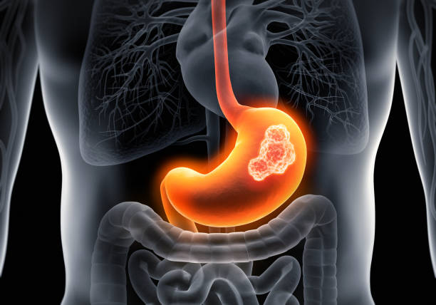 Complete Stomach Cancer Treatment at Livasa Hoshiarpur - Total Medications & Therapies