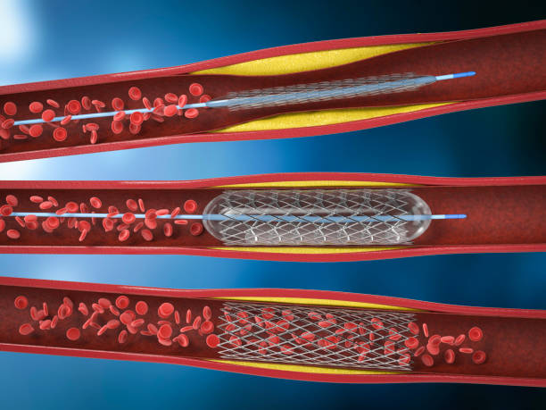 Informed Stent vs Bypass Consultation at Livasa Hoshiarpur - Personalized Heart Treatment