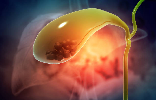 Dieting & Gallstones: How Weight Loss Can Affect Gallstone Formation in Punjab