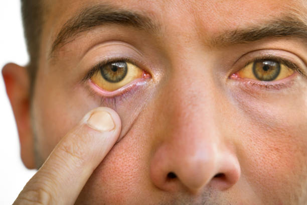 Jaundice & Hepatitis in Amritsar: When Yellow Eyes Mean Liver Trouble