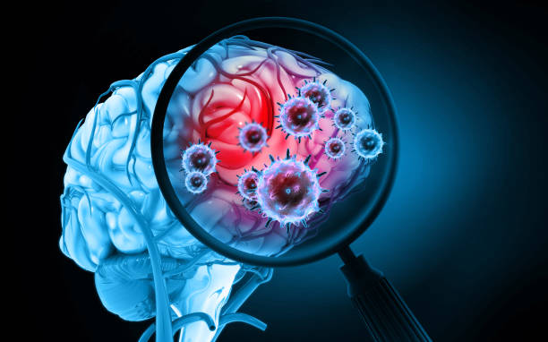 Acute Brain Infection: Viral & Bacterial Encephalitis Amritsar