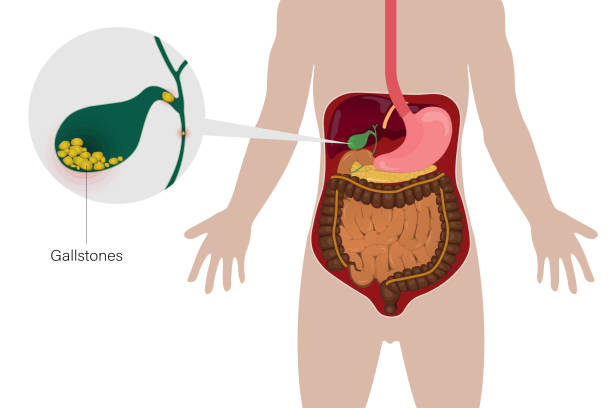 How Can You Prevent Getting Gallstones? Expert Tips for Punjab Patients