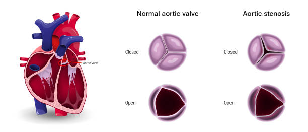 Advanced Aortic Stenosis Treatment at Livasa Amritsar - Modern Valve Solutions