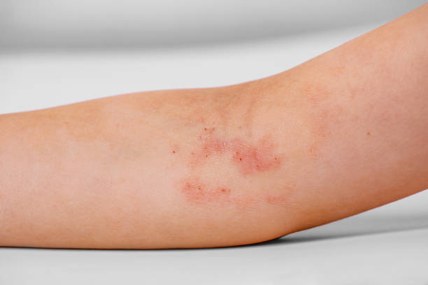 Home Remedies Related to Eczema in Amritsar