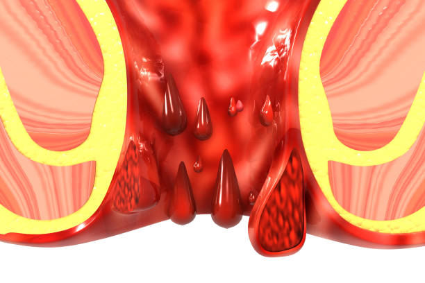 Is It Piles or Anal Fissures? Answers from the Best Piles Surgeon in Punjab