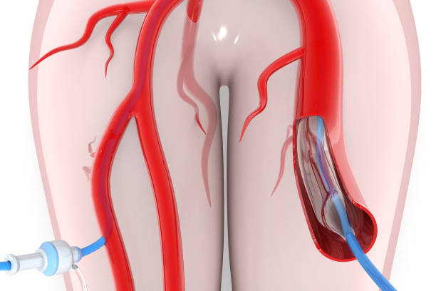 Educational Stent vs Bypass Consultation at Livasa Nawanshahr - Personalized Heart Treatment