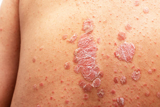 Age Specific Related to Psoriasis in Amritsar