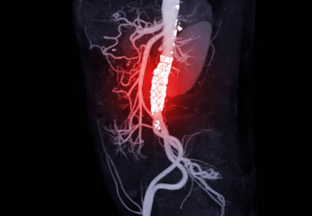 Aortic Aneurysm Detection & Surgical Repair Amritsar