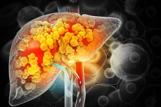 Complete Cirrhosis Complications Care at Livasa Hoshiarpur - Total Prevention & Management