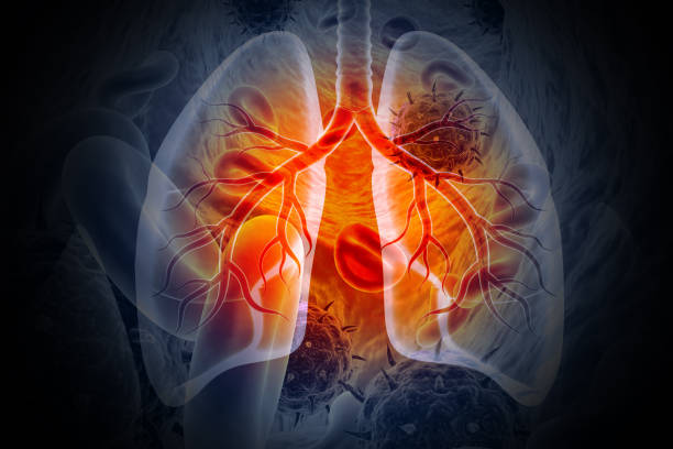 Individualized Lung Cancer Treatment at Livasa Hoshiarpur - Stage-Specific Care