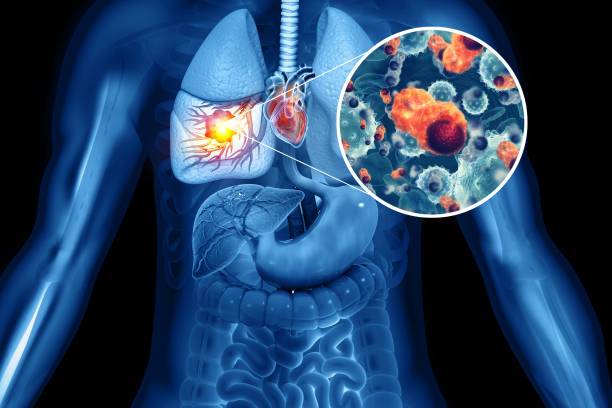 Complete Lung Cancer Stages & Symptoms Care at Livasa Hoshiarpur - Reliable Treatment