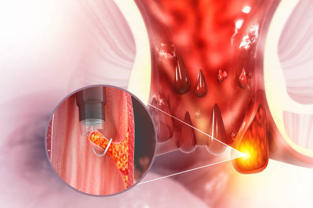 Know the Difference Between Piles and Fissure: Diagnosis and Treatment Options