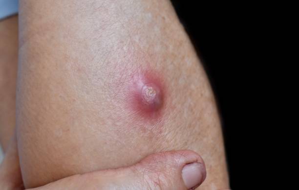 Abscess & Neuroinfection Treatment Amritsar