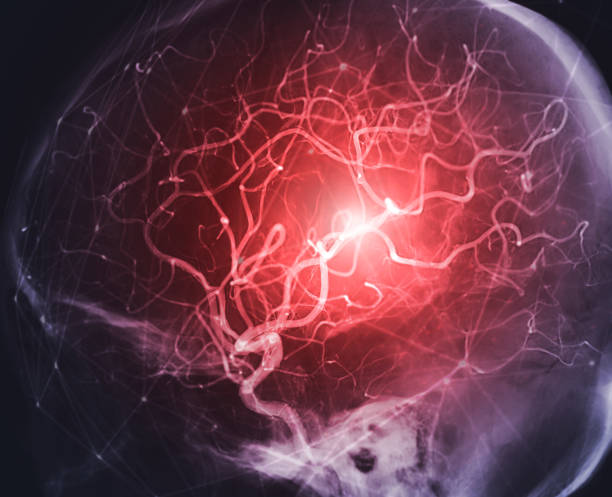 Cerebral Aneurysm Detection & Surgical Repair Amritsar