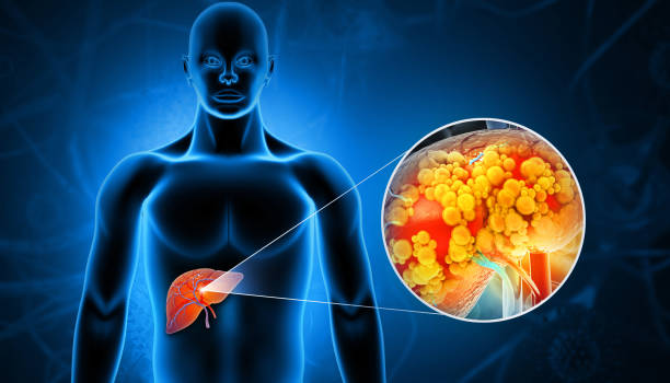 Focused Alcoholic Liver Disease Care at Livasa Hoshiarpur - Complete Treatment Journey