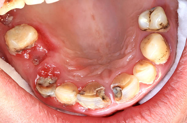 Focused Oral Cancer Recognition at Livasa Hoshiarpur - Reliable Late-Stage Symptom Assessment