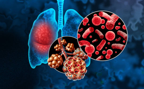 Age Specific Related to Lung Infection in Amritsar