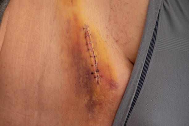 Laparoscopic Groin Hernia Repair: Procedure and Recovery in Punjab