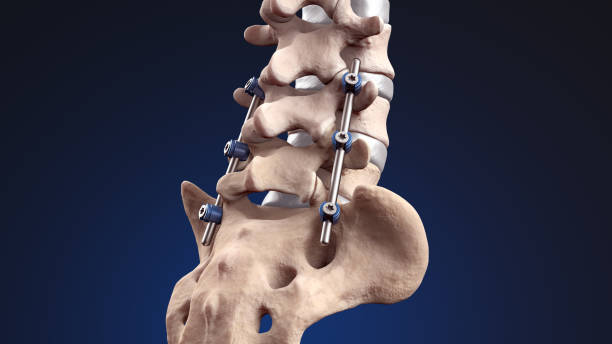 Stable Spinal Fusion at Livasa Nawanshahr - Steady Orthopedic Excellence