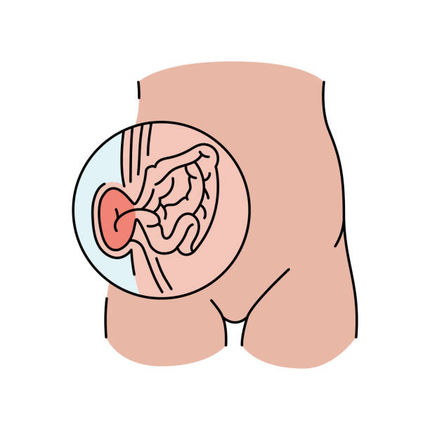 Measuring Inguinal Hernia Size: Why It Matters and How Livasa Hospital Punjab Helps