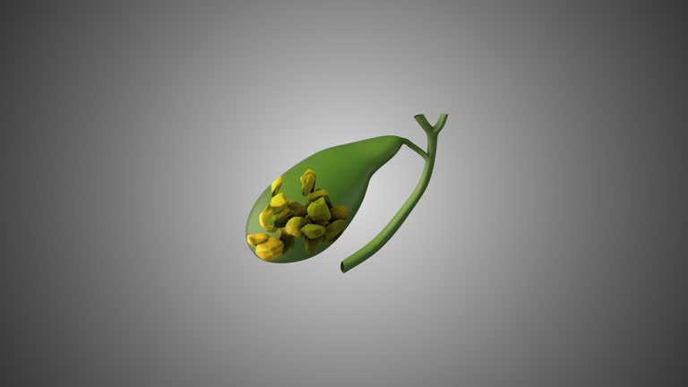Gallstones (Cholelithiasis): Symptoms, Causes & Treatment in Punjab