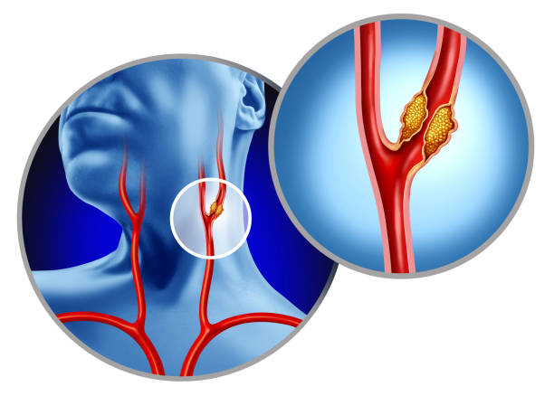 Carotid Artery Disease & Stroke Prevention Amritsar