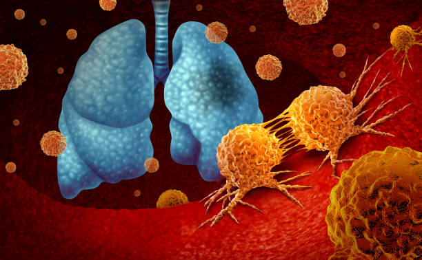 Focused Lung Adenocarcinoma Care at Livasa Hoshiarpur - Targeted Prognosis & Treatment
