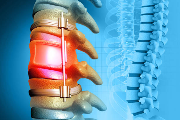 Detailed Spinal Stenosis Surgery at Livasa Nawanshahr - Comprehensive Spine Solutions