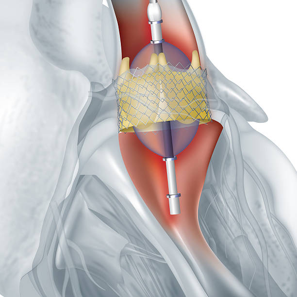 Heart Valve Replacement Cost in Amritsar: AVR, MVR & Double Valve Surgery