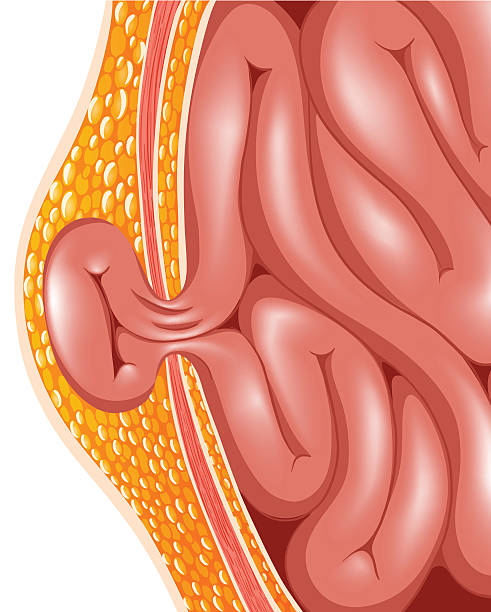 How CT Imaging Improves Diagnosis and Treatment of Abdominal Hernias