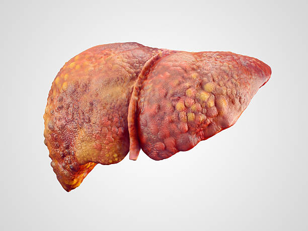 Liver Cirrhosis: Comprehensive Management and Treatment Options
