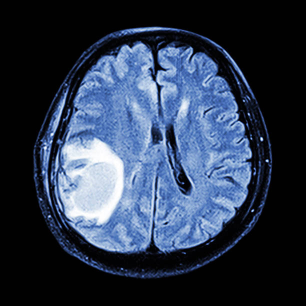 Precise Brain Tumor Diagnosis at Livasa Nawanshahr - Accurate Imaging & Testing