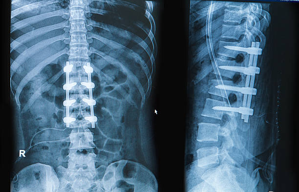 Professional Spinal Fusion at Livasa Amritsar - Proven Orthopedic Excellence