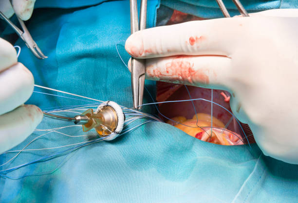 Focused Mitral Valve Surgery at Livasa Hoshiarpur - Targeted Cardiac Procedures