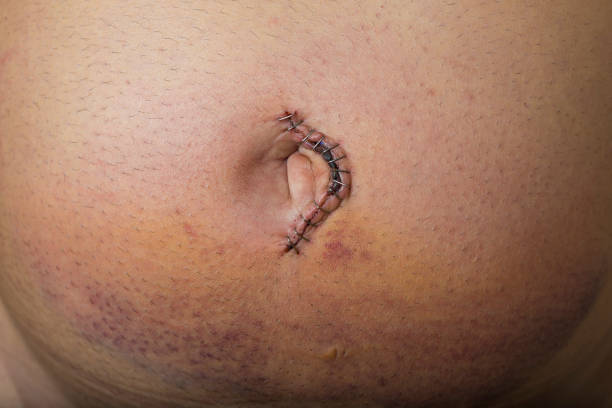 Safety of Hernia Mesh Inside the Body: Facts for Punjab Patients