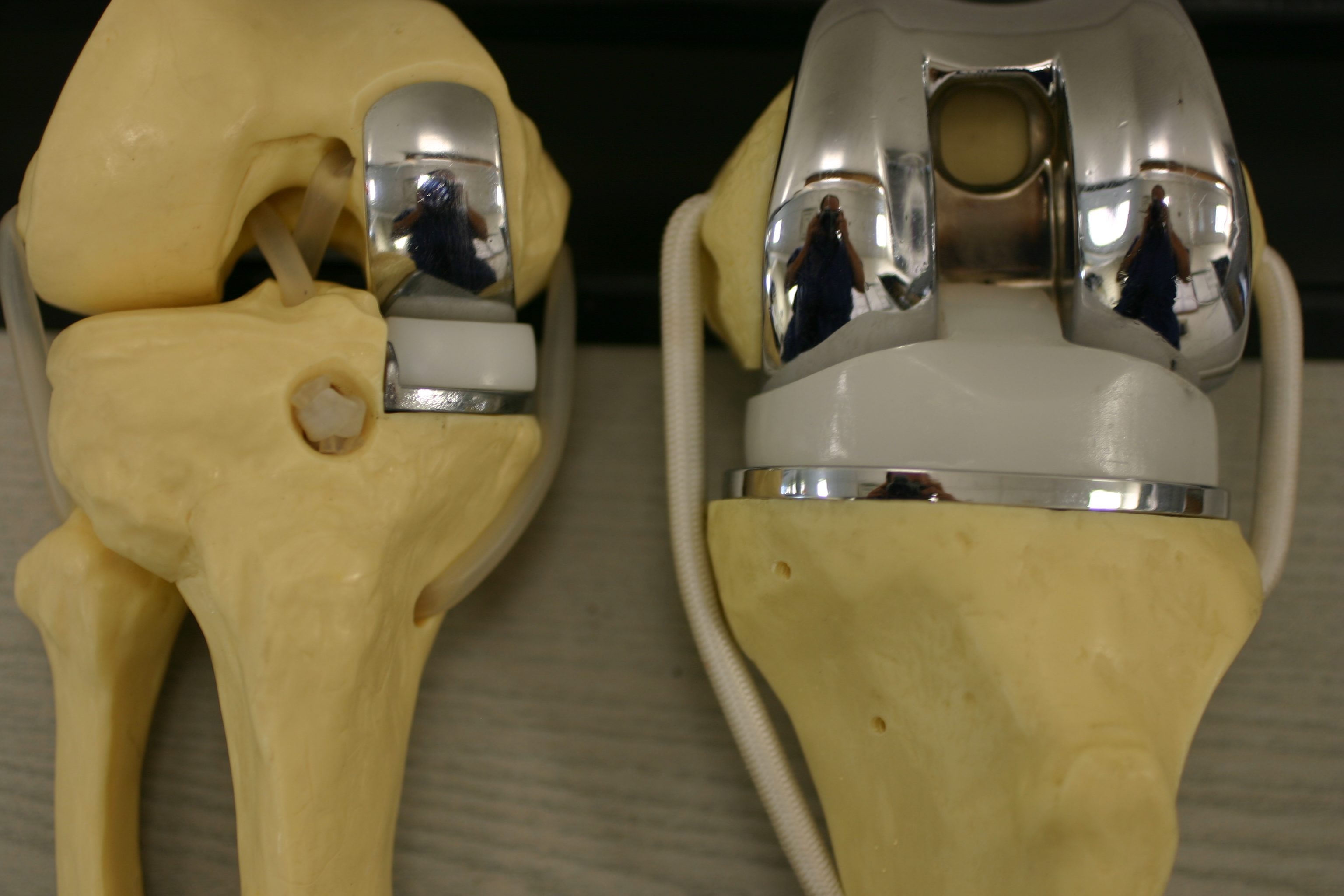 Partial vs. Total Knee Replacement: Which Is Right for You?