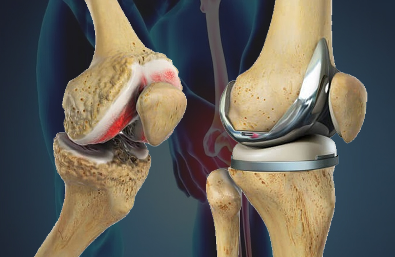 Top 5 Mistakes to Avoid After Knee Replacement Surgery