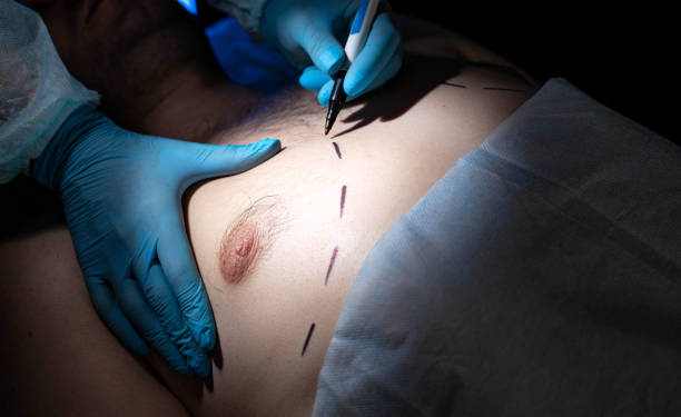 Breast Reduction Surgery for Women: Pain Relief and Cost in Mohali