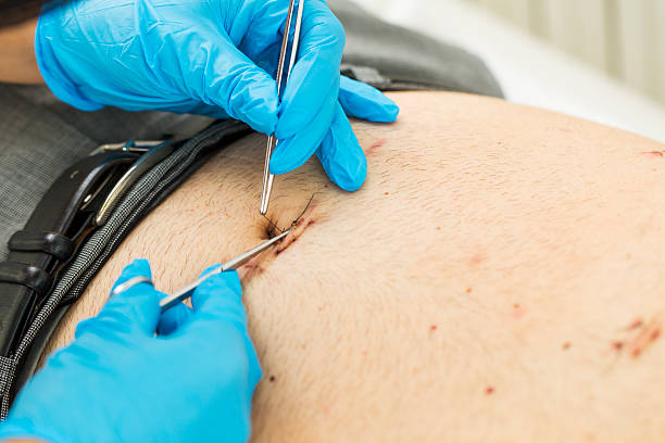 Gallbladder Stone Surgery: Laparoscopic vs Open in Mohali