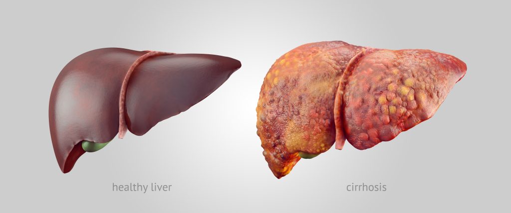 Liver Fibrosis vs Cirrhosis at Livasa Mohali - Understanding Progression